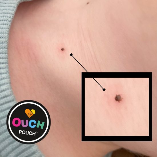 Removing a tick from achild
